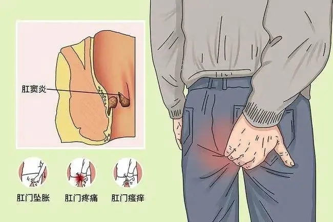 肛门坠胀大便失禁_肛门坠胀大便失禁_肛门坠胀大便失禁