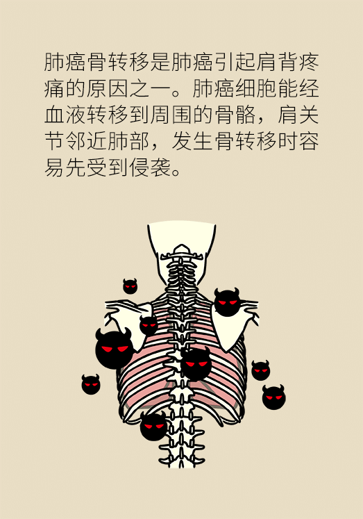 后背疼呼吸困难是肺癌吗_后背疼痛肺癌_深呼吸后背疼是肺癌吗