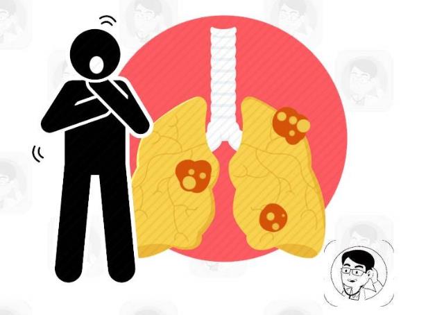 肺癌咳嗽白痰_咳嗽白痰肺癌_咳白痰是肺癌的前兆吗
