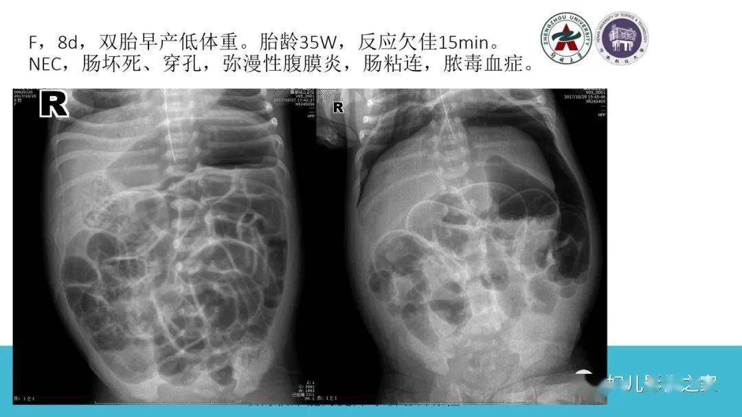 小肠x线分6组示意图_小肠线样征_小肠x线表现