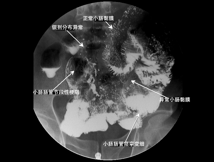 小肠x线表现_小肠x线分6组示意图_小肠线样征