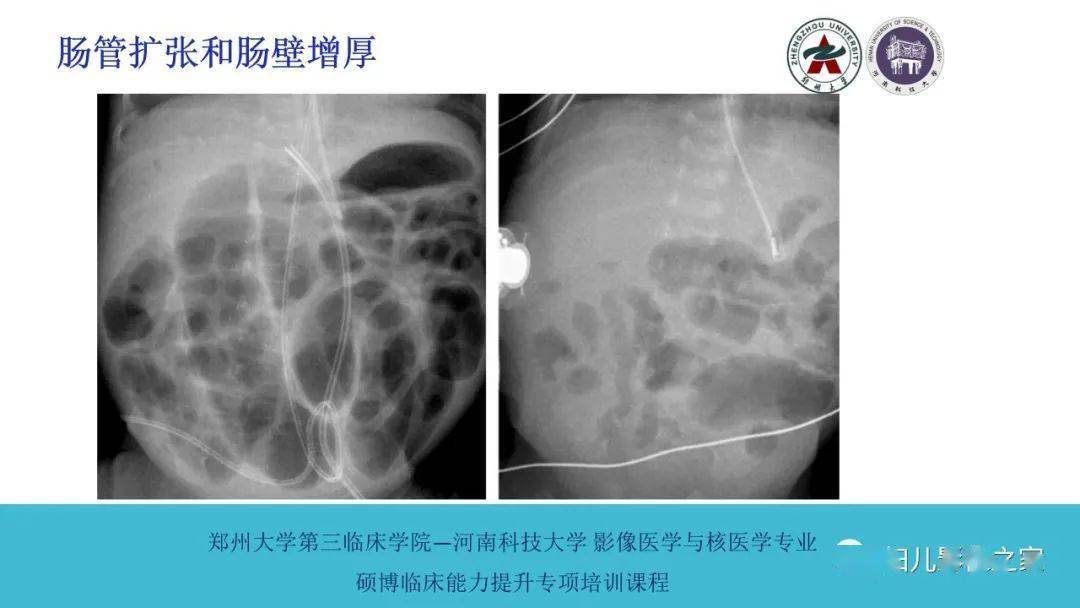 小肠x线表现_小肠线样征_小肠x线分6组示意图