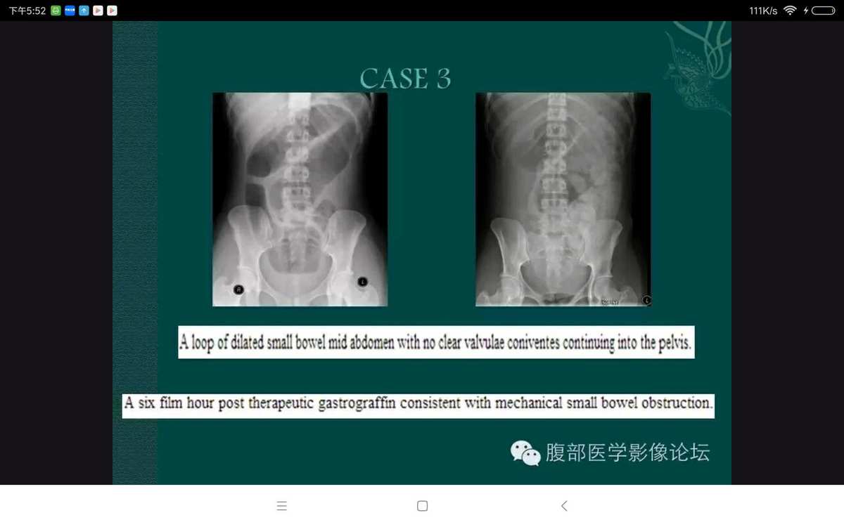 小肠x线分6组示意图_小肠线样征_小肠x线表现