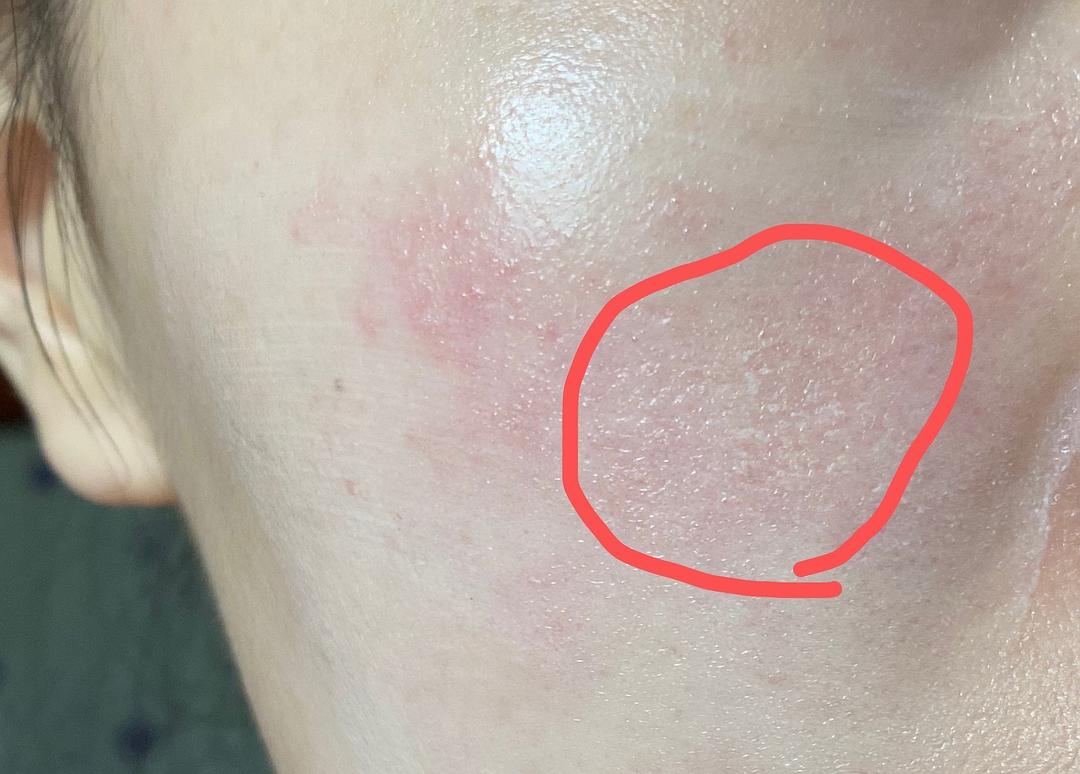 脸部发痒脱皮怎么办_脸脱皮很痒_脸部脱皮痒怎么办