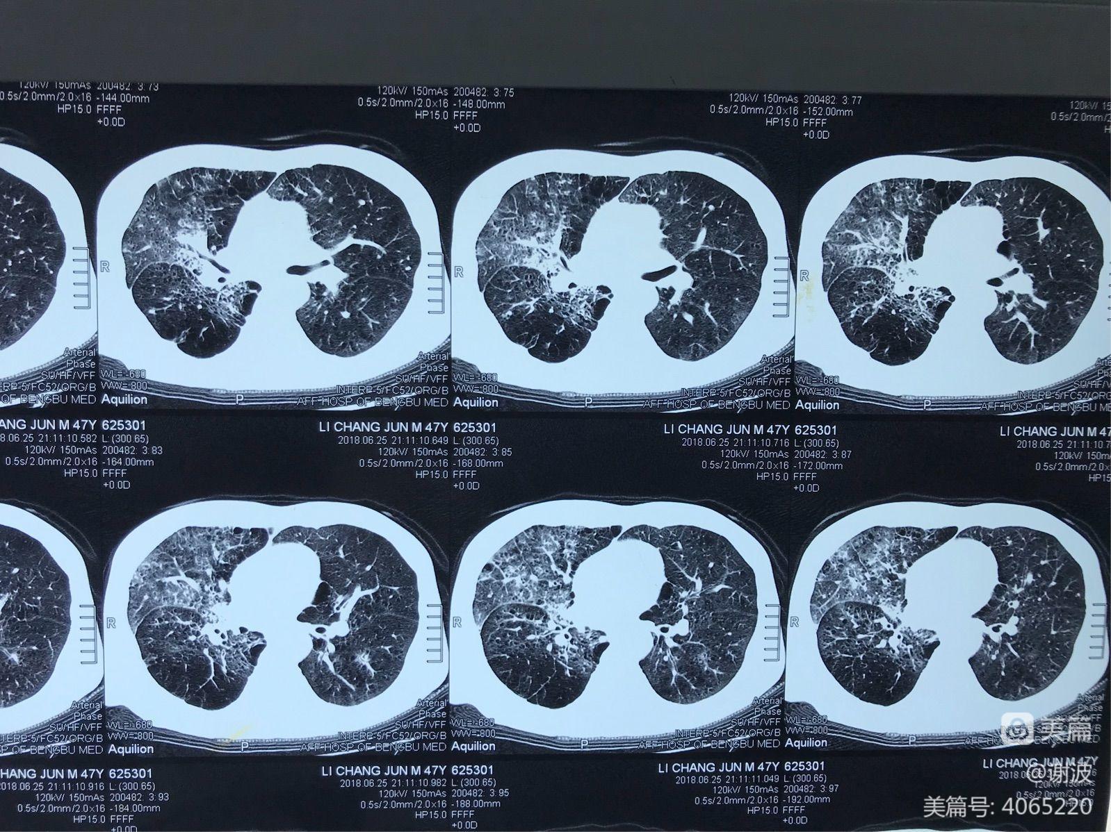 继发性肺结核注意事项_肺事项结核性继发注意事项包括_继发性肺结核应注意什么