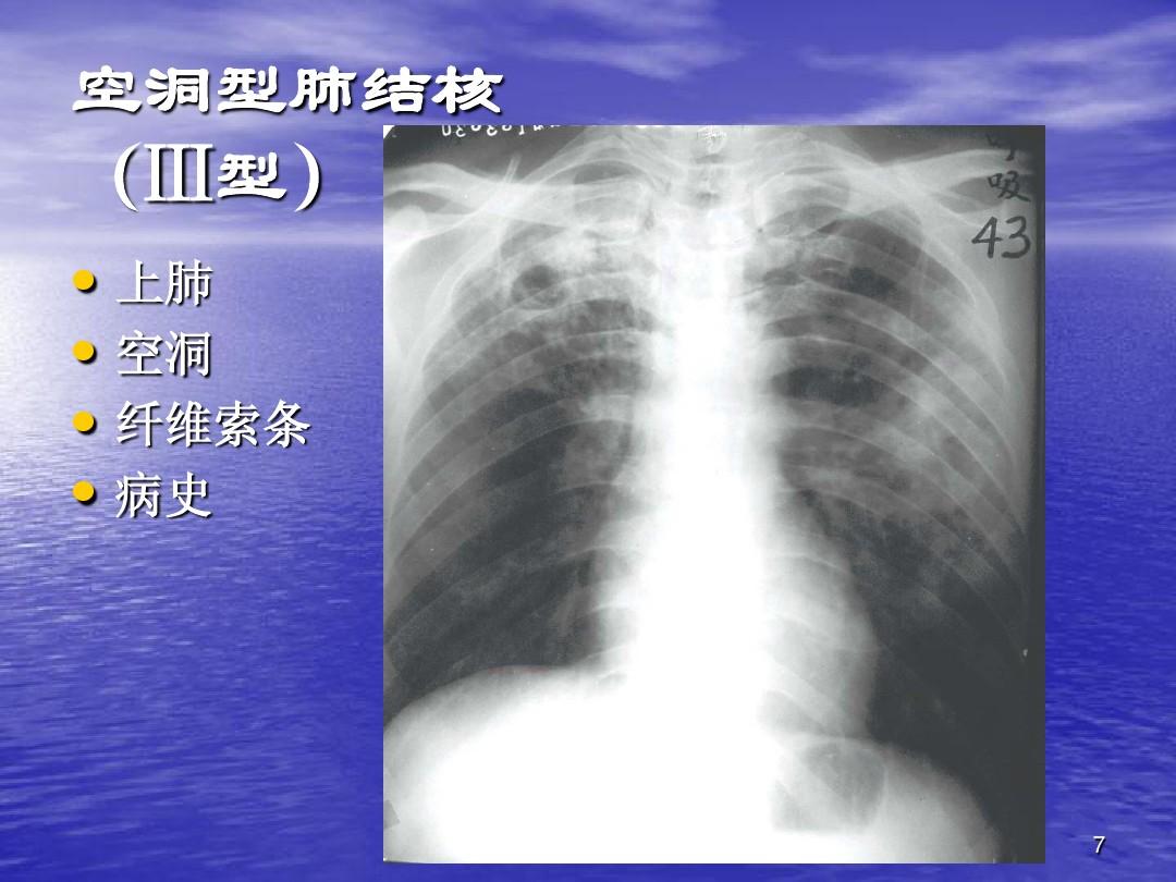 肺结核严重性分几个程度_肺结核的严重程度分类_三型肺结核严重吗