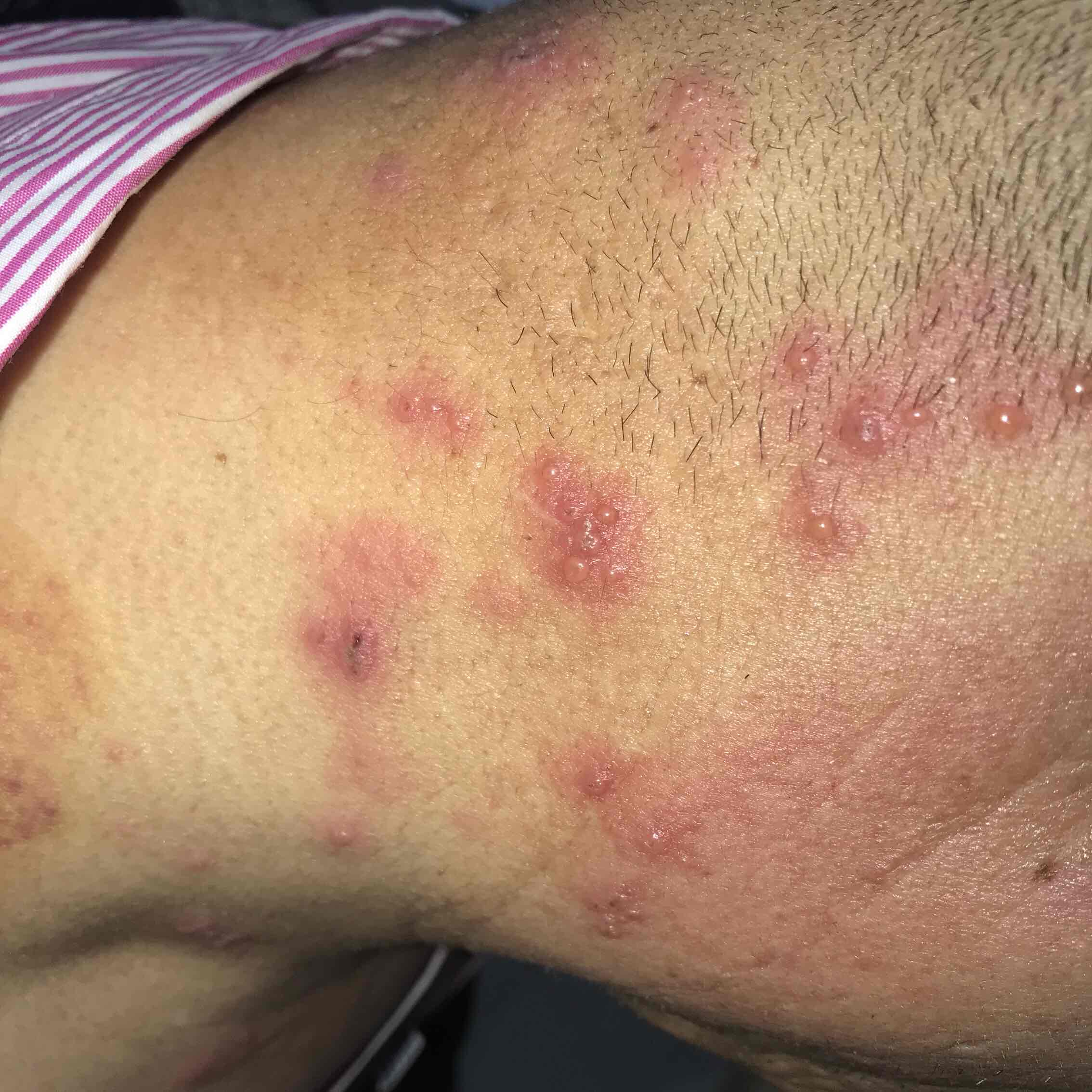 后背疼痛后出现红泡_前胸后背疼 还有红色的水泡_前胸后背疼起水泡是什么病