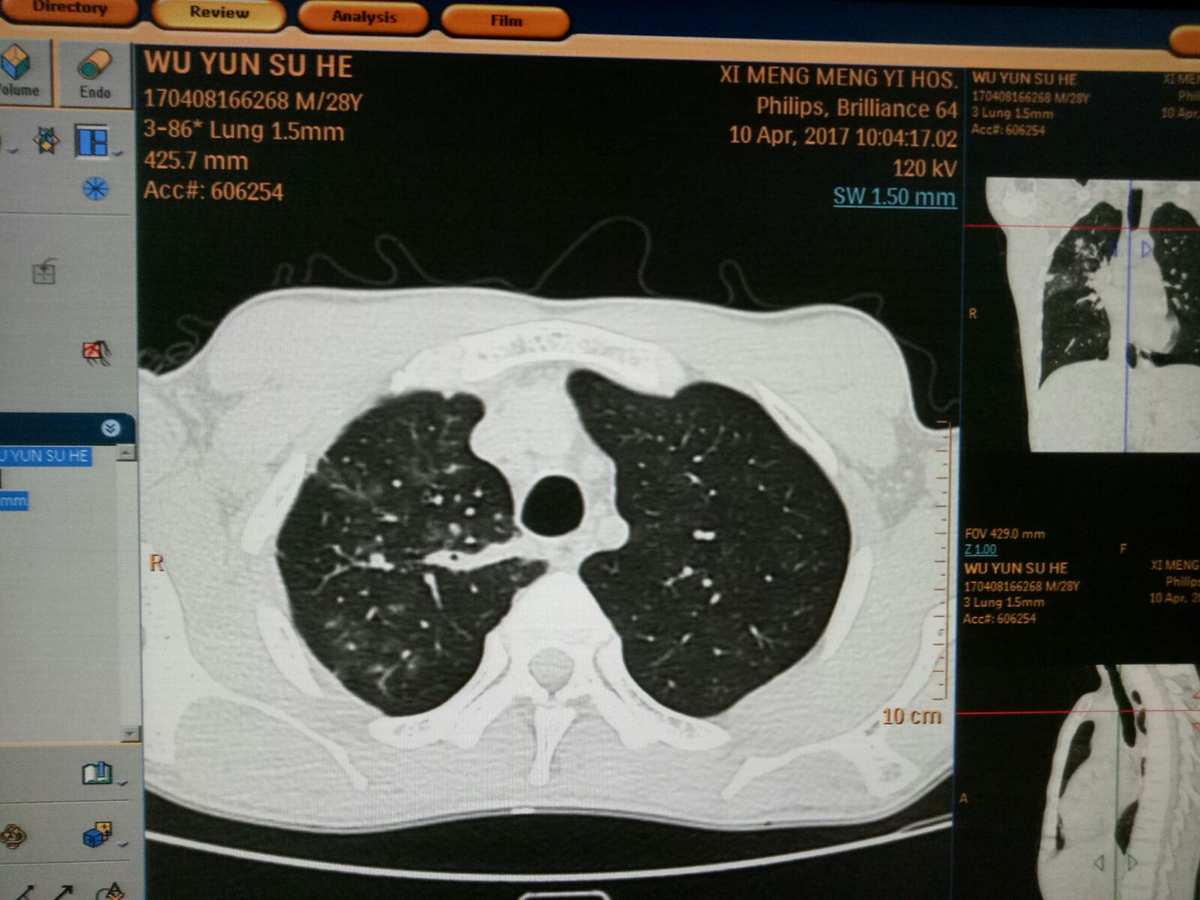 浸润肺结核能治好吗_肺能浸润结核自愈型病变吗_浸润型肺结核能自愈吗