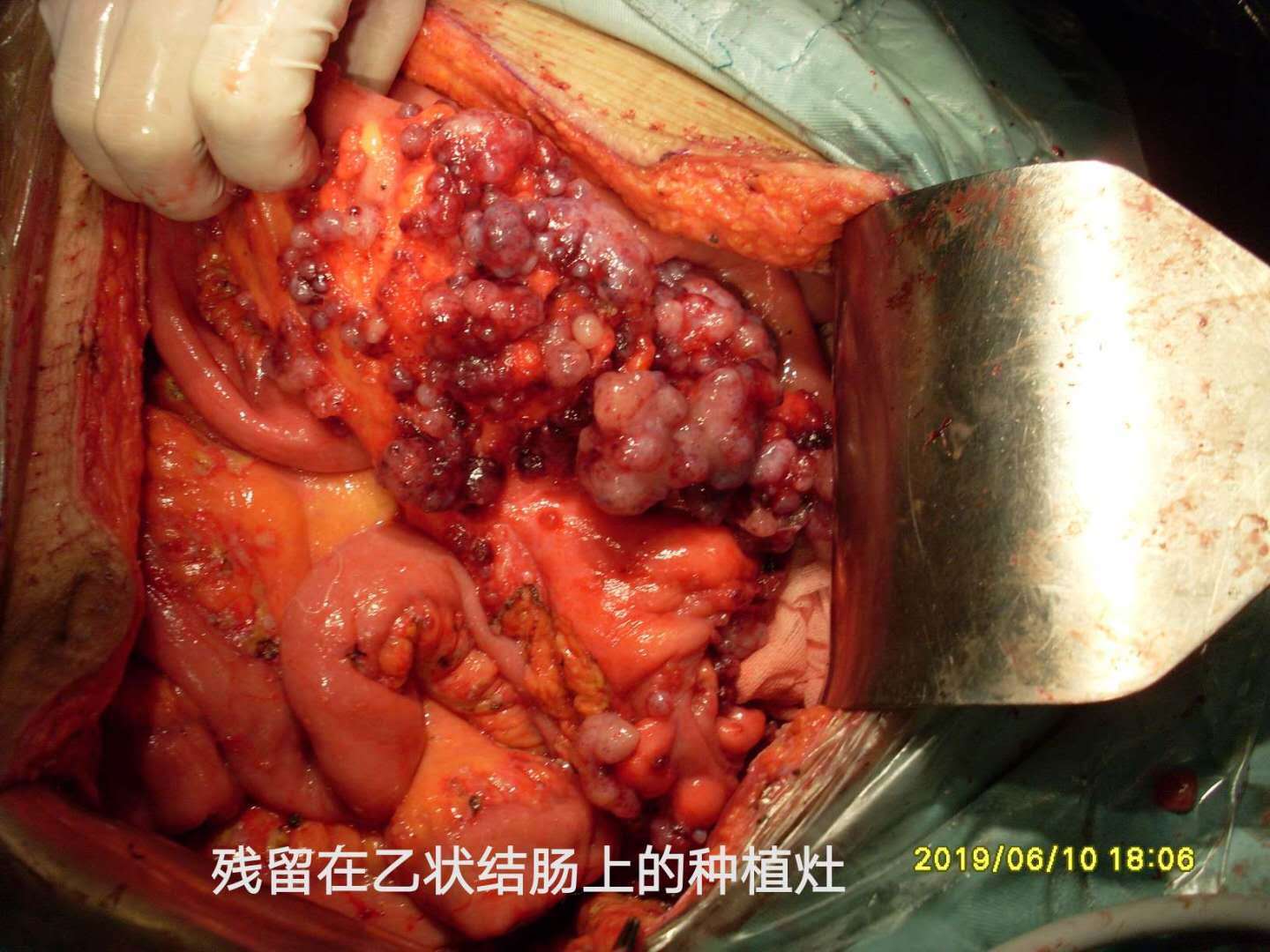 急性盲肠炎术后吃什么_急性盲肠炎 手术要多久_急性盲手术肠炎要住院几天