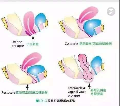 肛门轻度漏气失禁能自愈吗_肛门轻度失禁肛门漏气_肛门轻度漏气失禁怎么治疗