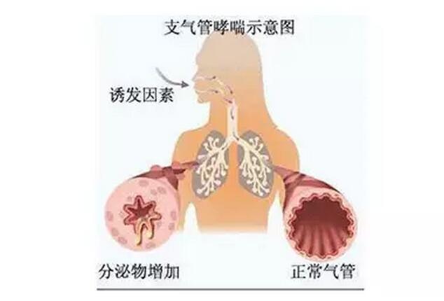 儿童哮喘影响生命吗_哮喘孩子的症状_明星小孩哮喘的症状