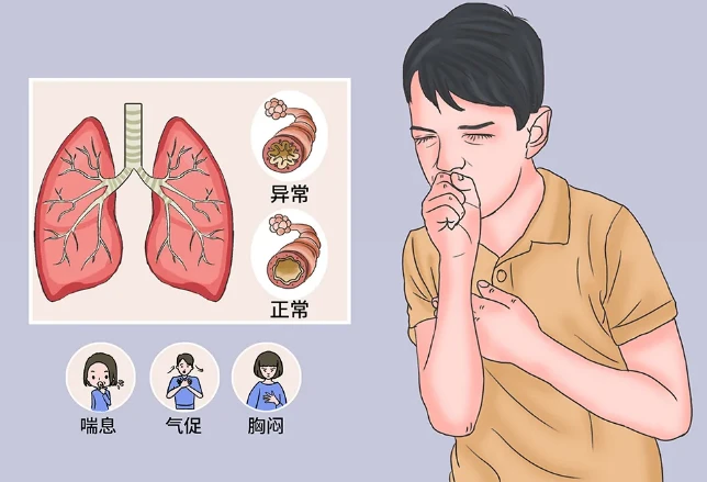 早期哮喘怎么办_早期哮喘有什么症状_哮喘早期得到了规范治疗还会范吗