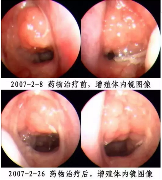 回盲部腺样征_回盲部腺体增生_回盲部线样征见于