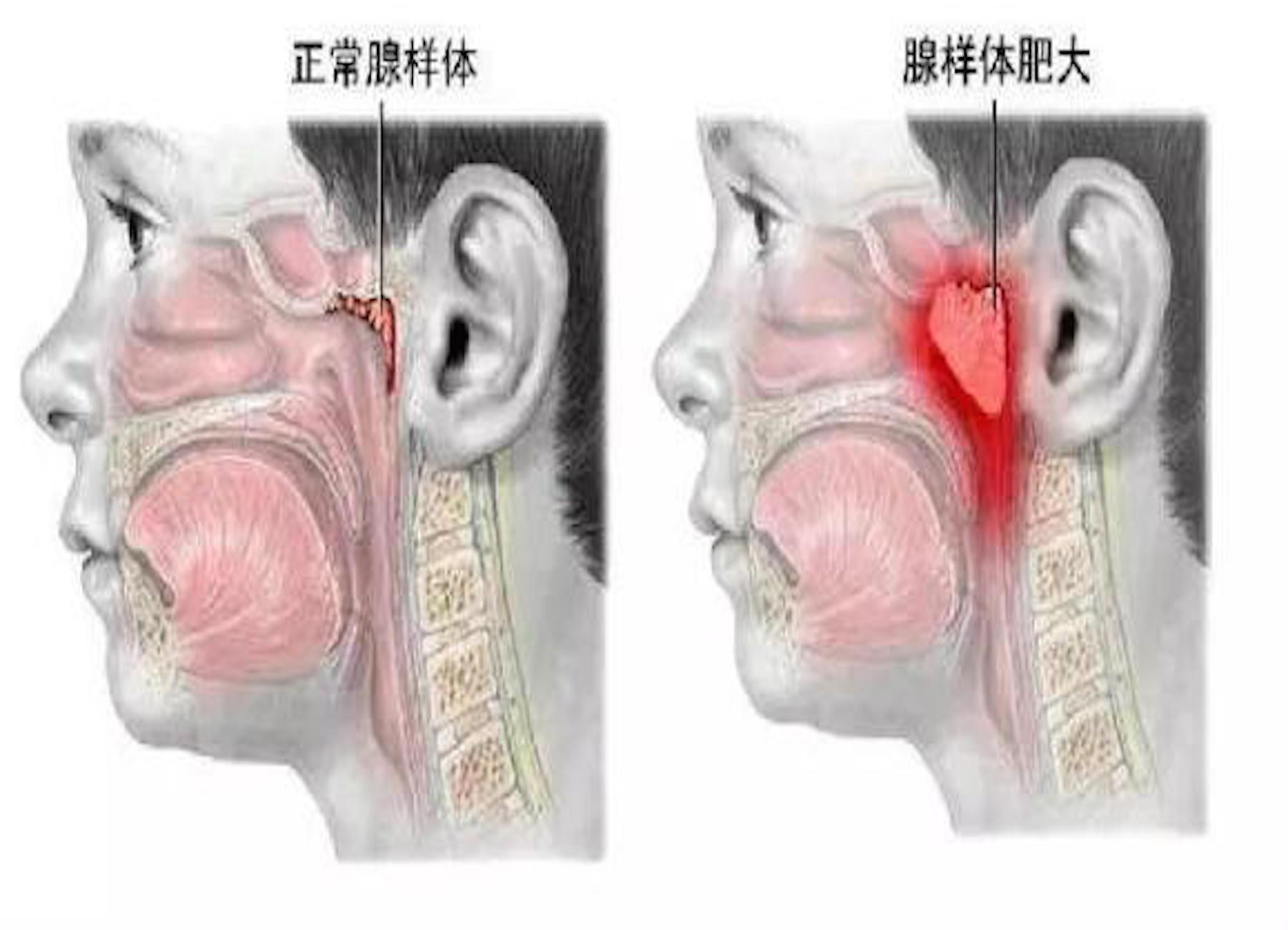 回盲部线样征见于_回盲部腺体增生_回盲部腺样征