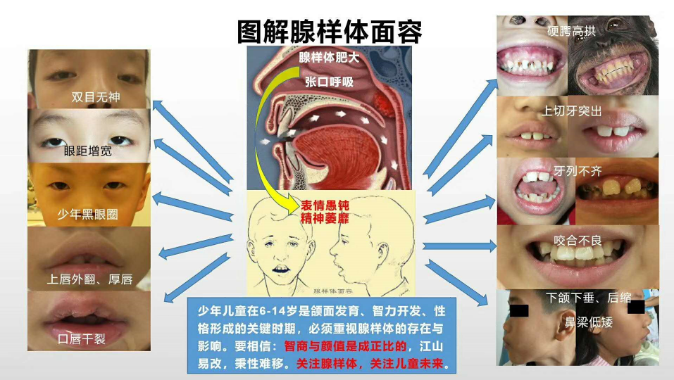 回盲部线样征见于_回盲部腺样征_回盲部腺体增生