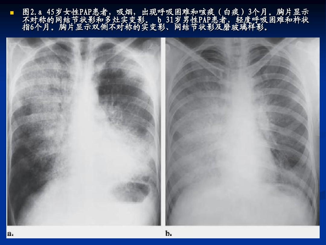 肺泡蛋白沉积症_肺泡蛋白质沉积症会传染吗_肺泡蛋白沉积症并发症