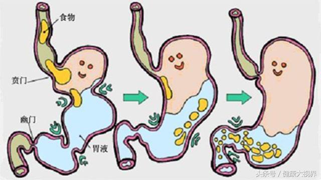 治疗胃病的康复新液_康复新液治愈胃病案例_康复新液治胃病吗