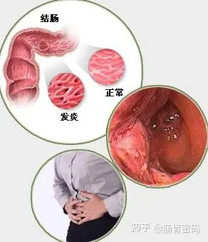 大便克罗恩病_肠炎克罗恩_克罗恩肠炎的大便症状