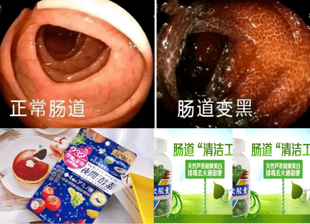 克罗恩病克罗恩肠炎治疗_罗克罗恩病_罗克恩病能治好吗