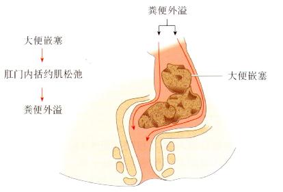 肛门失禁_肛门失禁_肛门失禁