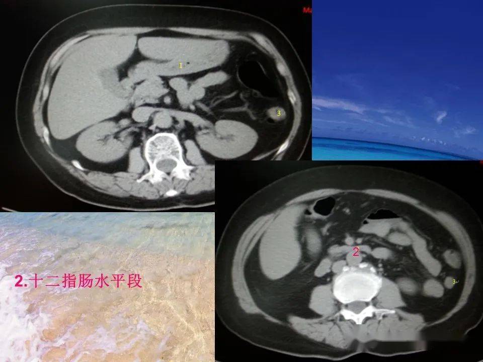 消化道穿孔影像学图片_消化道穿孔ct图片_消化道穿孔典型ct图片