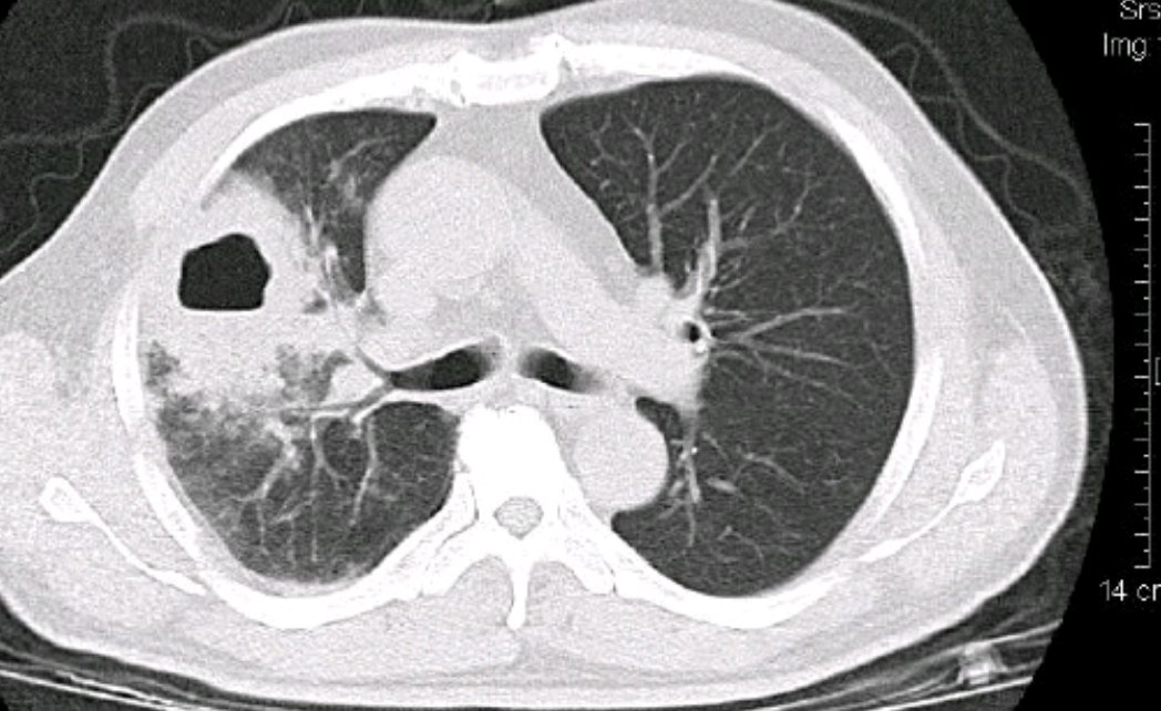肺结核CT空洞图片