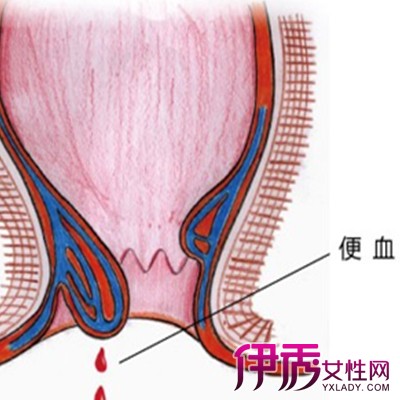 肛门拉大便出鲜血是怎么回事_大便出鲜血便后肛门疼怎么回事_大便出血肛门有血