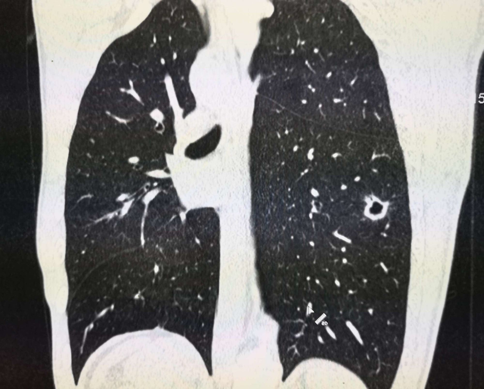 肺空洞有良性的吗_肺上有空洞_肺空洞有毛刺一定是癌症吗
