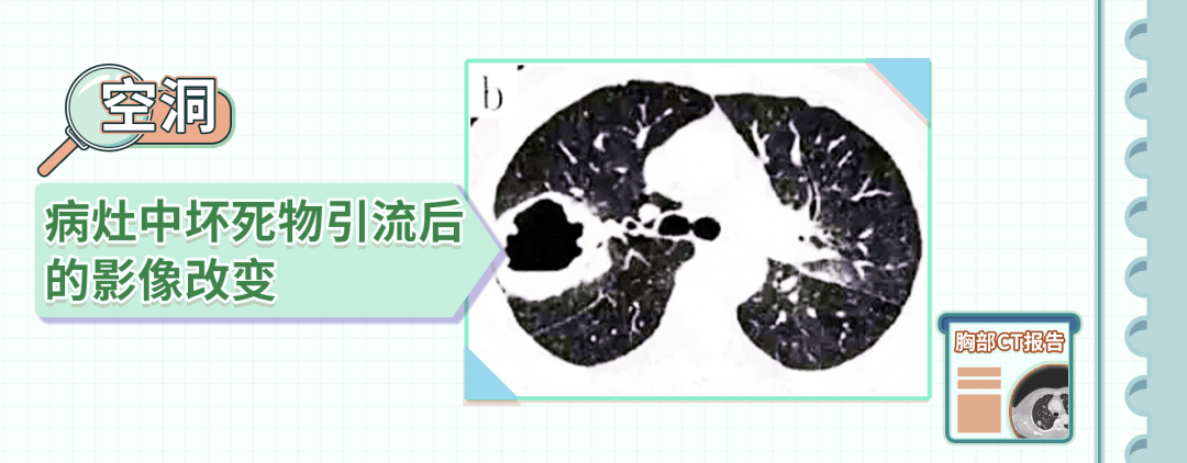 肺上有空洞_肺空洞有良性的吗_肺空洞有毛刺一定是癌症吗