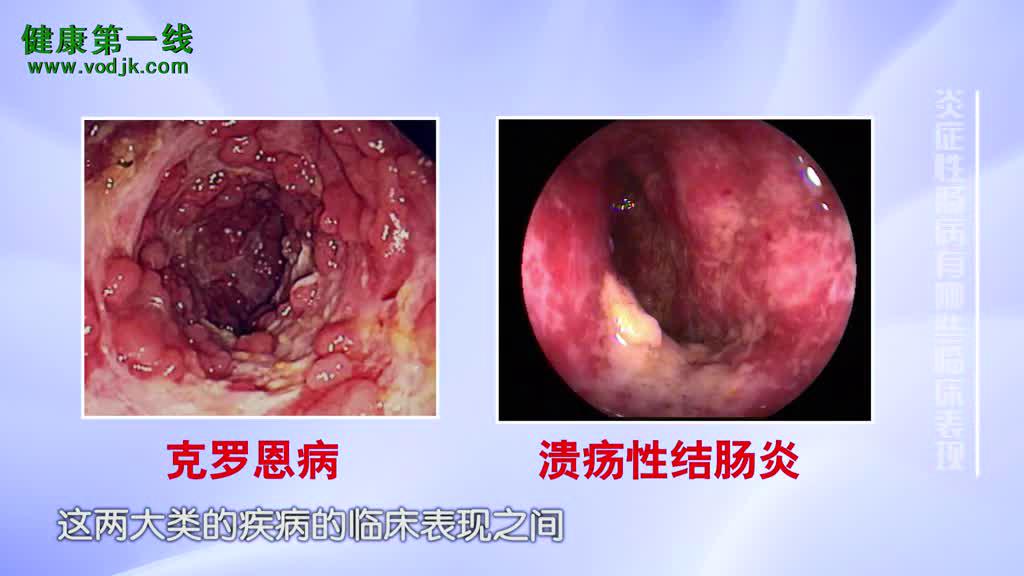 治疗克罗恩新药ged0301_罗恩克病_治克罗恩最有用的新药