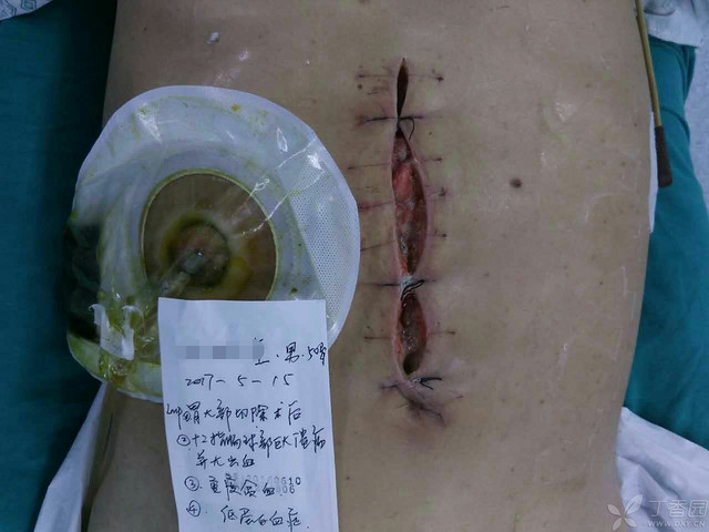 愈合手术肛瘘时间长吗_肛瘘手术愈合时间_肛瘘手术愈合过程