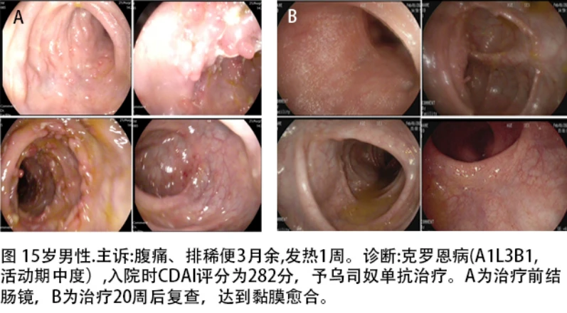 克罗恩病 内镜_克罗恩病简化内镜评分_克罗恩病胶囊内镜