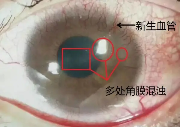 新生儿白眼珠蓝色_新生儿白眼球发蓝_新生儿白眼珠发蓝