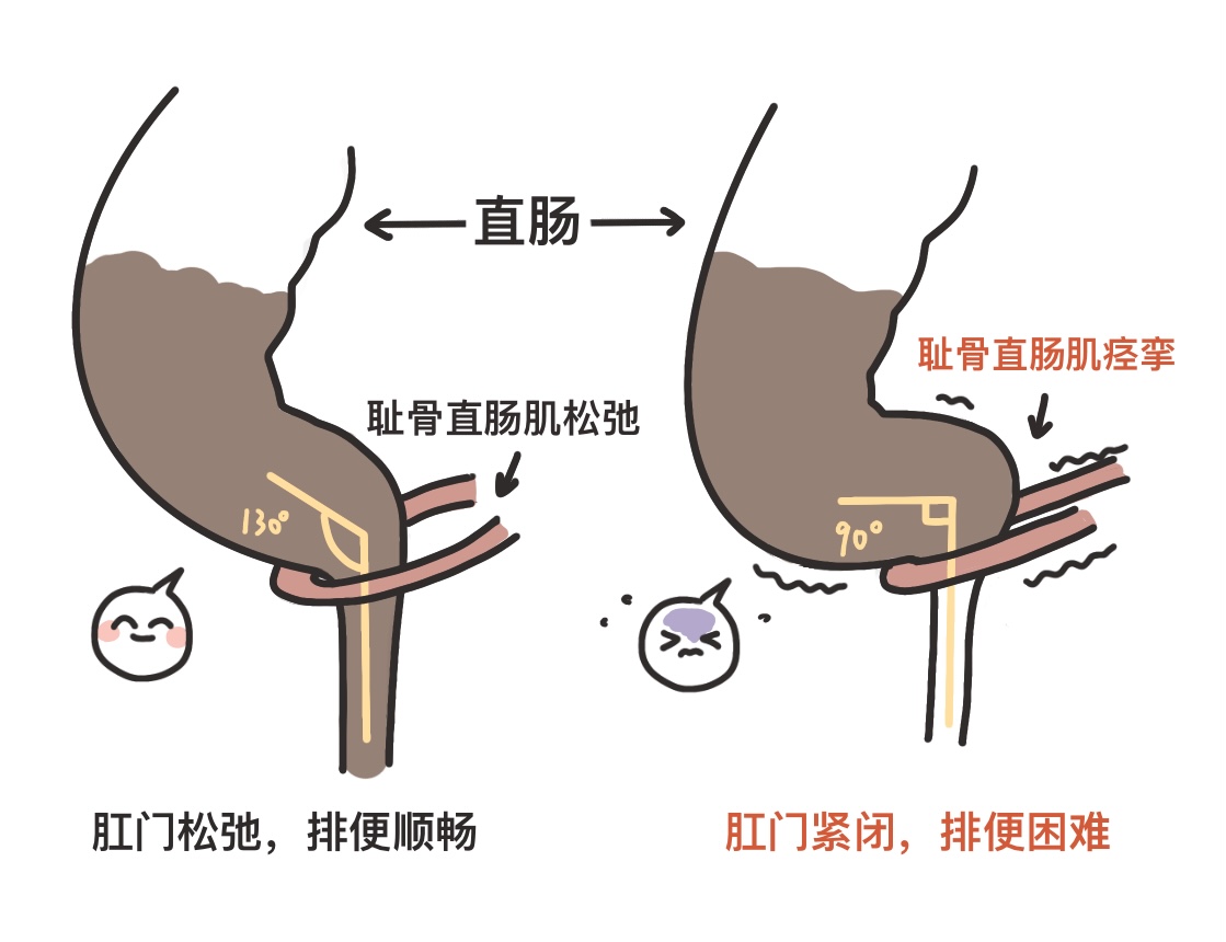 肛门轻度失禁肛门漏气_肛门漏气可以自愈吗_肛门轻度漏气失禁严重吗