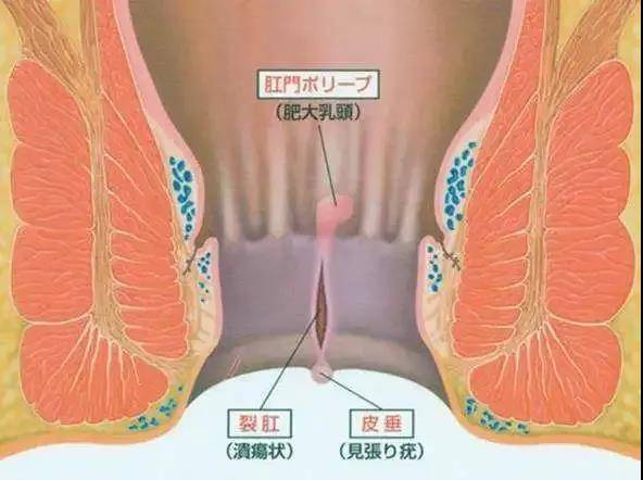 肛门漏气可以自愈吗_肛门轻度失禁肛门漏气_肛门轻度漏气失禁严重吗