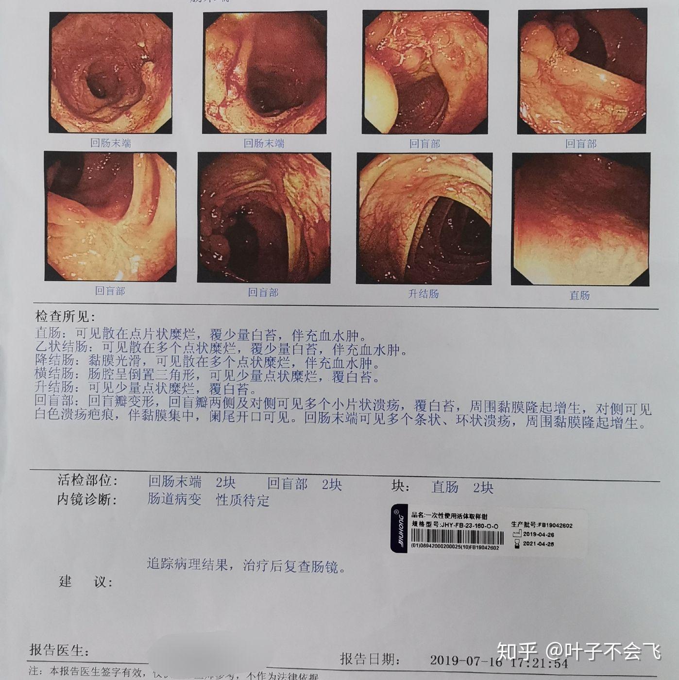 克罗恩可以痊愈吗_罗恩克病_克罗恩治好了