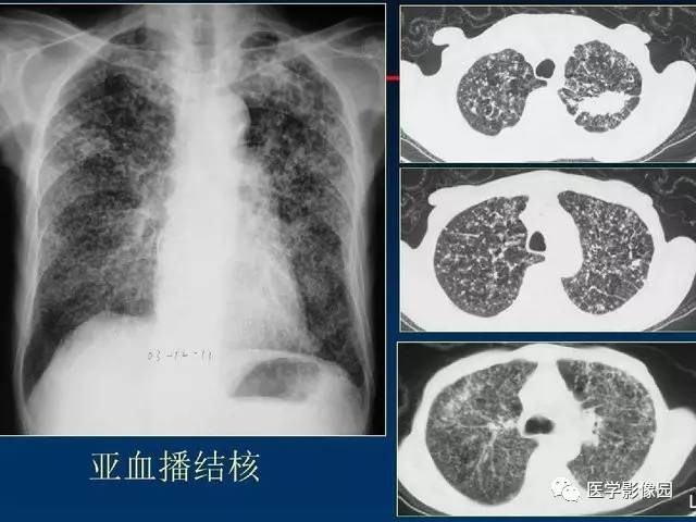 肺结核三级会传染吗_三级肺结核能活多久_三级肺结核严重吗