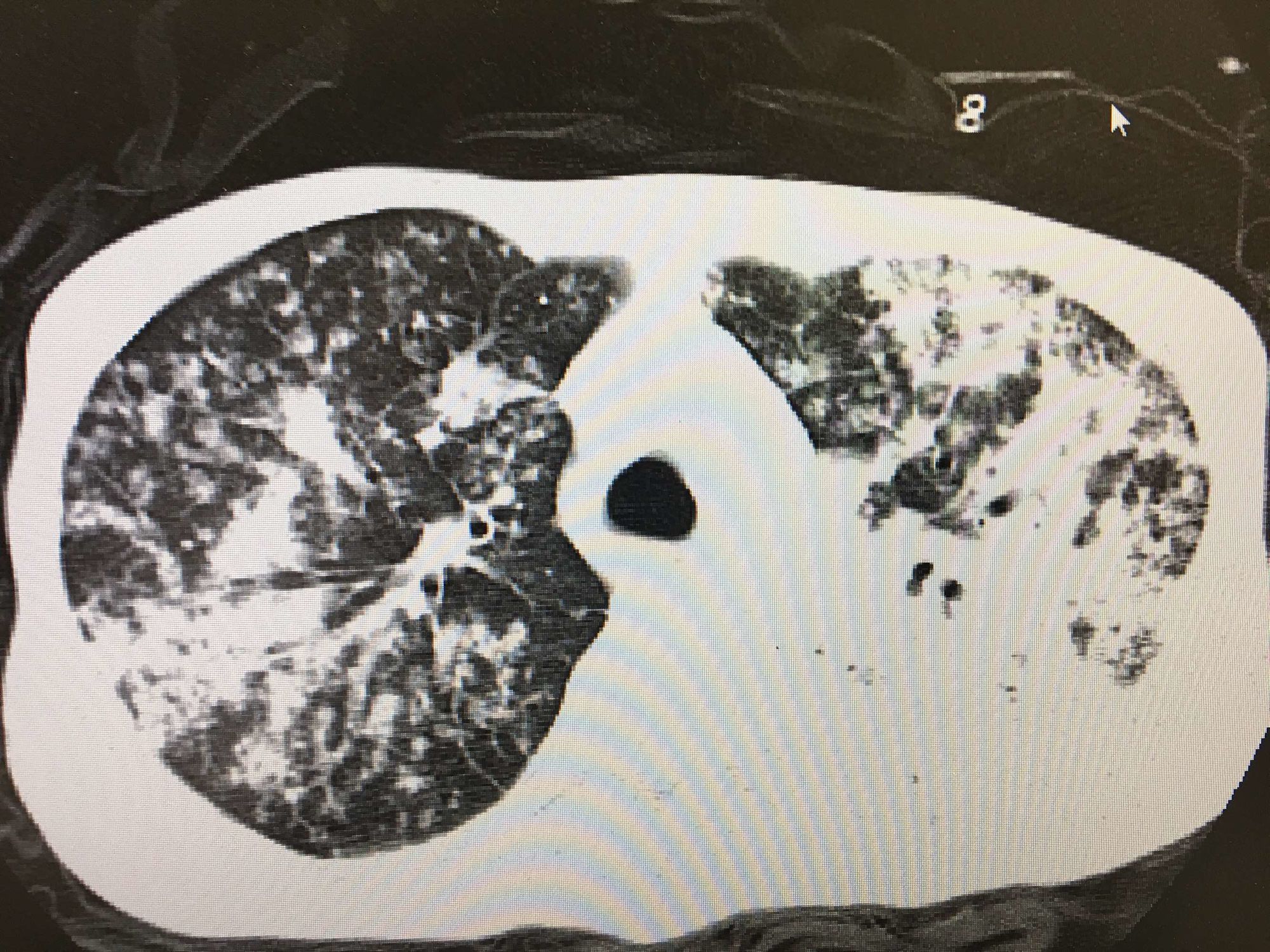 三级肺结核能活多久_三级肺结核严重吗_肺结核三级会传染吗