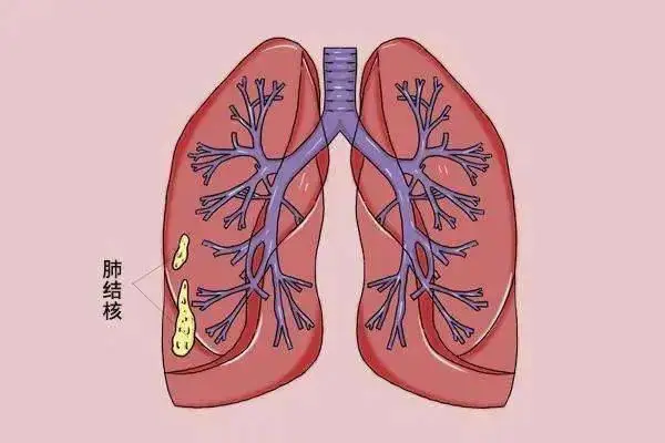 肺结核咳白痰有传染性吗_肺结核咳白痰_肺结核咳嗽白痰怎么办