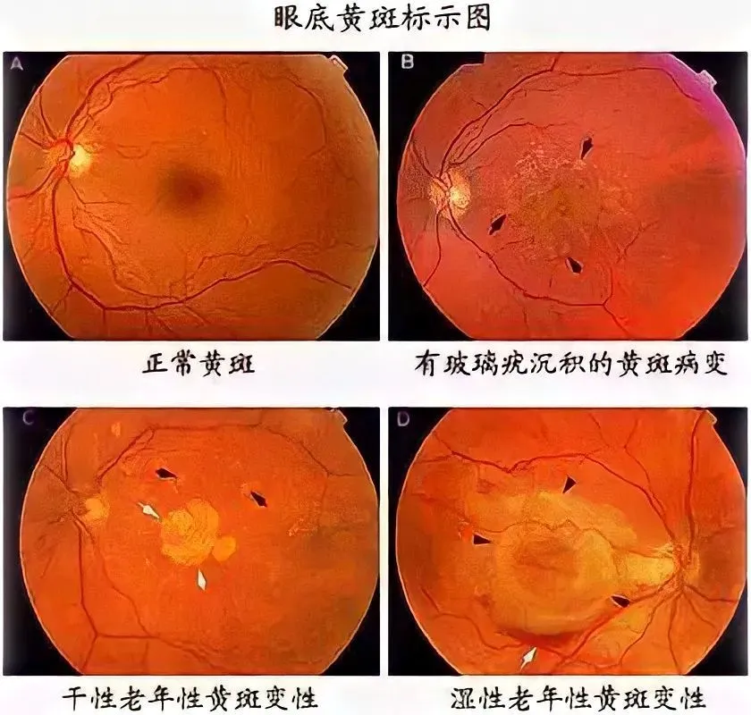 眼球白发蓝是什么原因_眼球回事白发蓝是怎么回事_白眼球发蓝是怎么回事