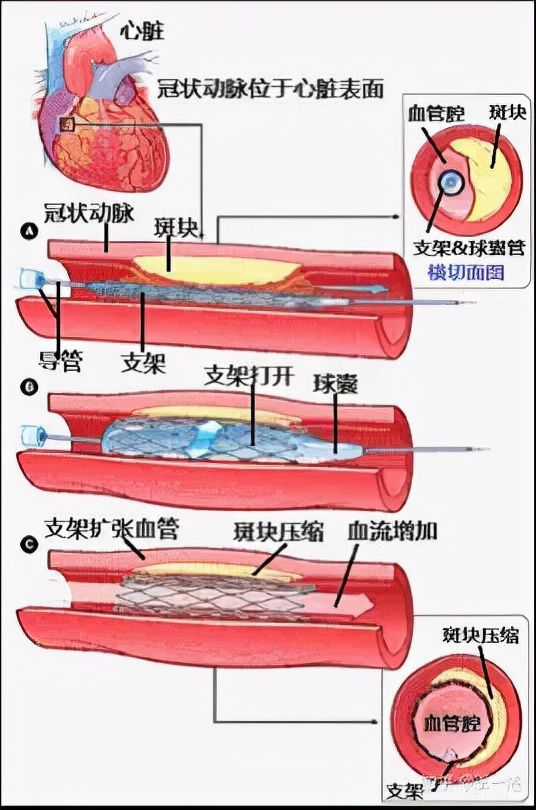 冠心病疑难病例讨论_冠心病患者疑难病例讨论_病例冠心病疑难讨论范文