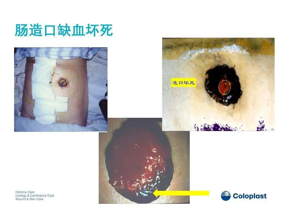 急性阑尾炎并发症的护理_急性阑尾炎术后并发症护理_急性阑尾炎术后并发症护理