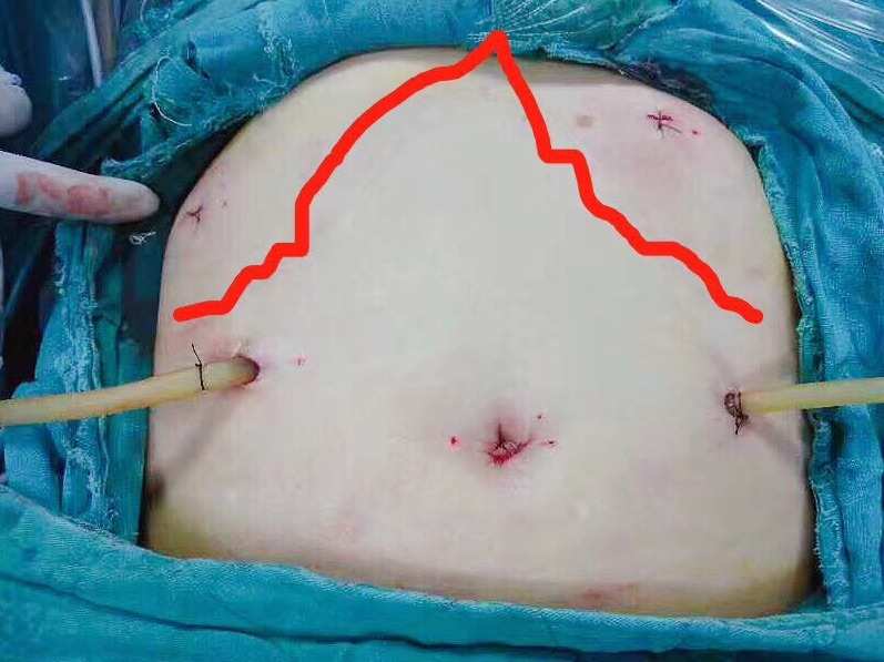 肛瘘手术多长时间长好_肛瘘多久做手术_肛瘘手术多久和正常人一样