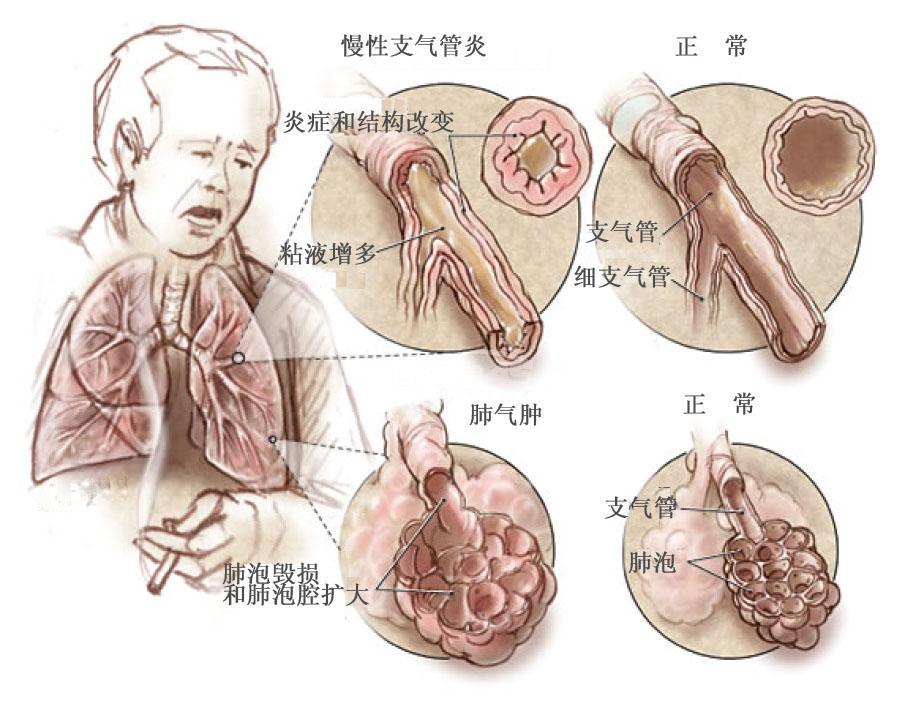 肺感染白痰_肺感染白痰变黄痰_肺部感染白痰