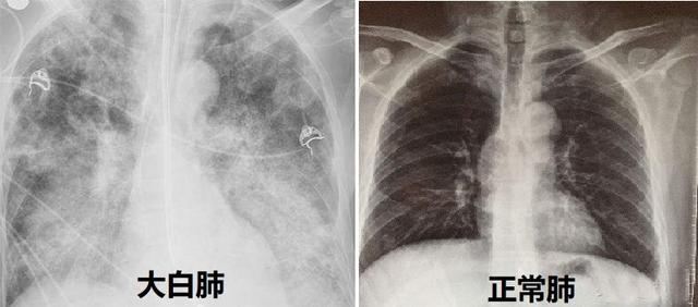 白肺现象_肺白是怎么回事_白肺症状