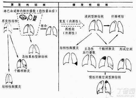 继发性肺结核严重吗_肺结核继发性肺结核_肺结核继发症