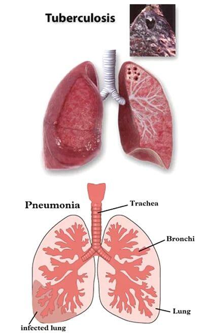 肺结核继发症_肺结核继发性肺结核_继发性肺结核严重吗