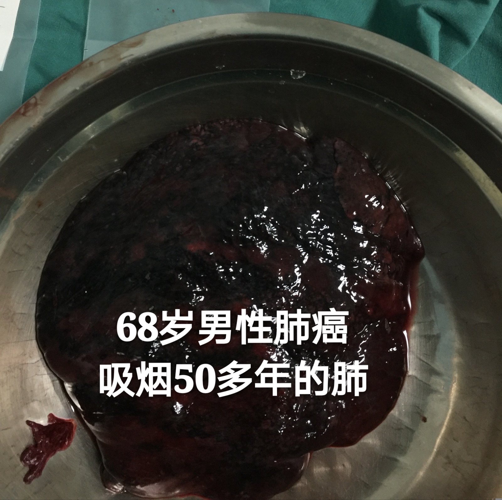 肺蛋白沉积有治愈的吗_肺蛋白沉积_肺蛋白沉积症是癌症吗