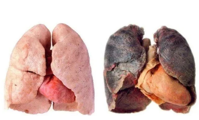 肺蛋白沉积症是癌症吗_肺蛋白沉积_肺蛋白沉积有治愈的吗
