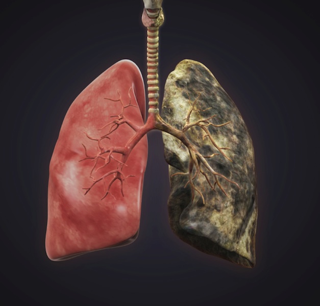 肺蛋白沉积有治愈的吗_肺蛋白沉积_肺蛋白沉积症是癌症吗